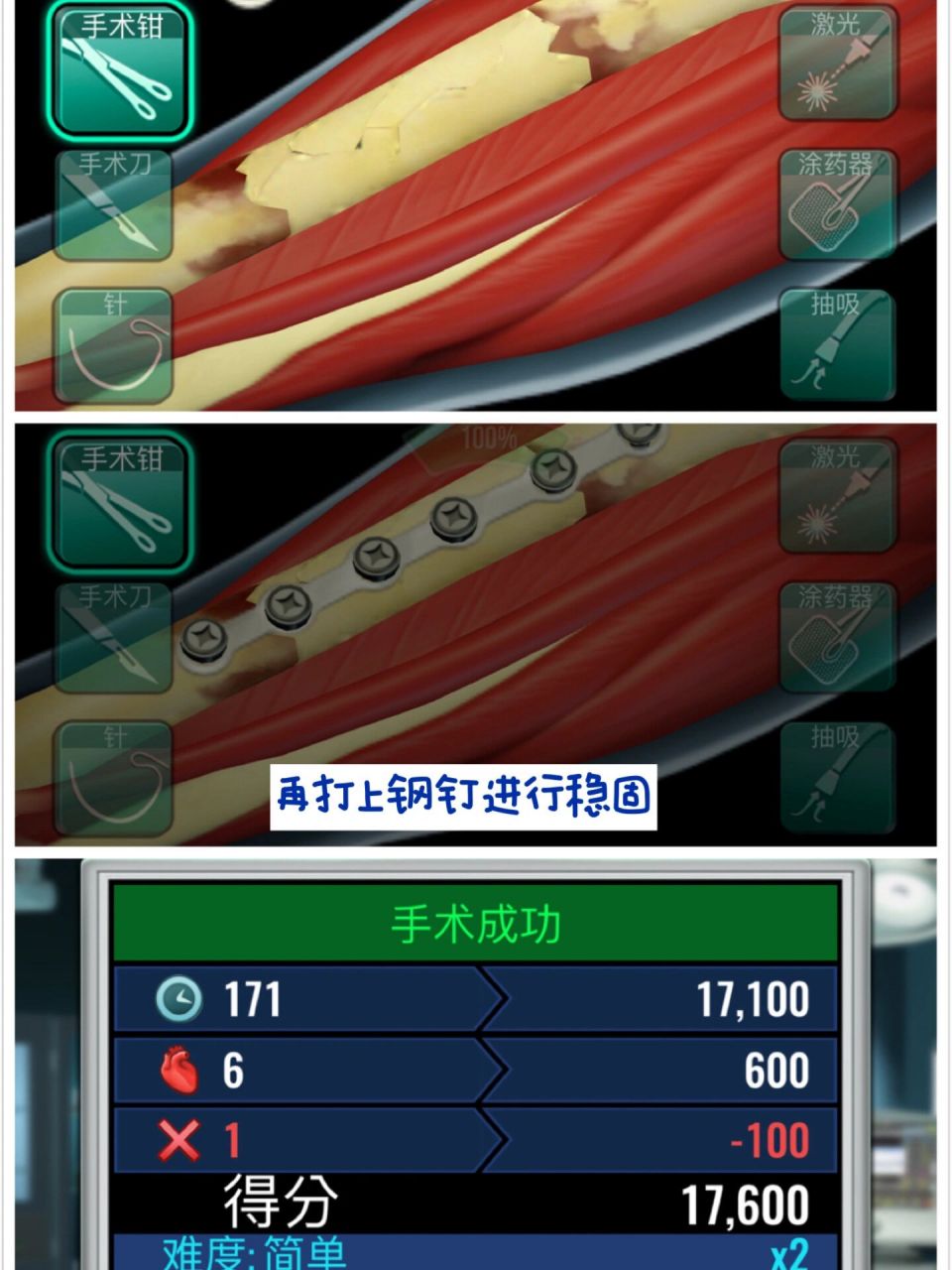 手术在线安卓版外痔手术视频实拍